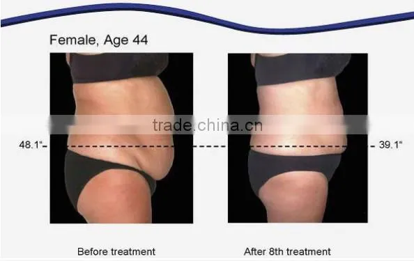 multifunctional lipolaser cavitation rf beauty machine / laser rf skin treatment machine