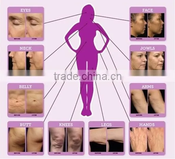 2015 Hot New Fractional RF Micro Needle Facial Machine/ Home Infrared Skin Tightening Machine