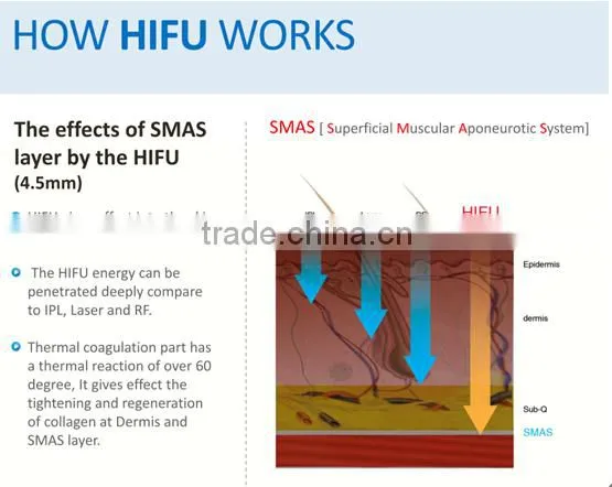 High intensity focused ultrasound anti-aging hifu ultra face lifting machine for spa