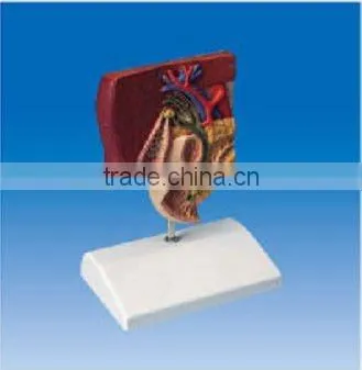 Gallstone model ,Anatomical modle of gallstone