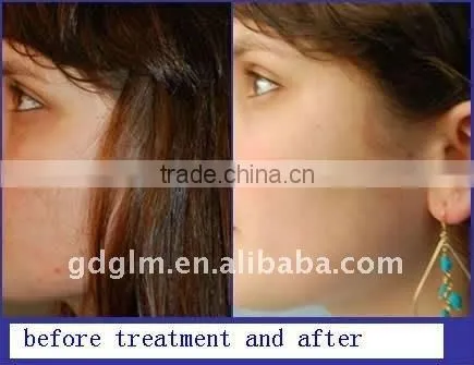 Portable Elight beauty equipment for permanent hair removal
