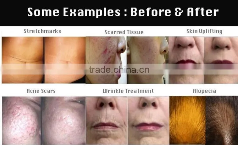 1080 needles body derma roller