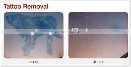 Germany lamp Nd: YAG Laser tattoo removal 1064/532/1320nm