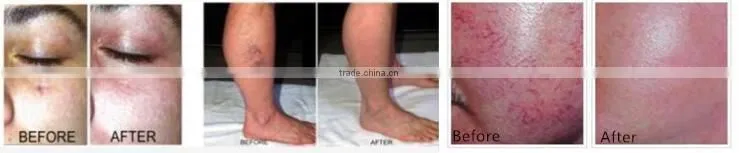 Diode laser 980nm vascular machine for spider vein removal