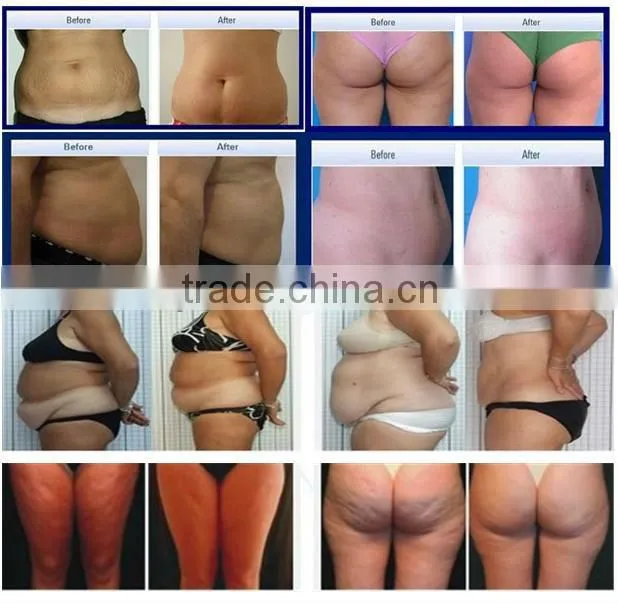 cavitation,lipolysis,vacuum, bipolar rf and tripolar rf multifunction beauty instrument with CE