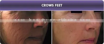 Hot selling auto micro needle system stretch mark removal