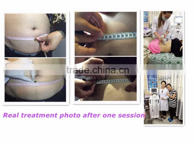slimming beauty machine liposonix depilatory machine