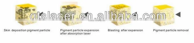 Best choices for beauty salon, strong power q switch nd yag laser skin rejuvenation /tattoo removal removal laser machine