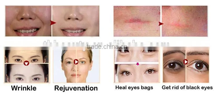 Handheld wrinkle remover derma roller eye massager derma roller