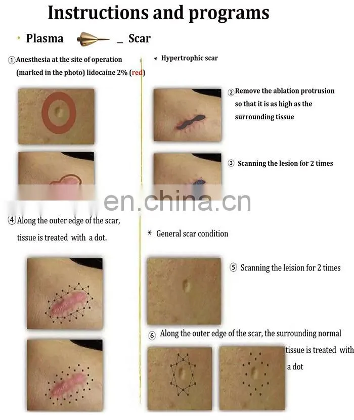 Newest Repair Expert Eye lift Wrinkle Removal Plasma Pen for Sale