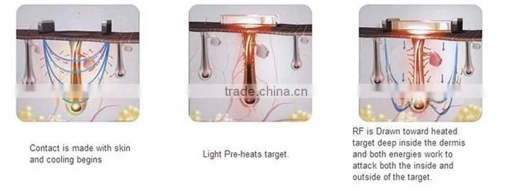 elight hair removal machine ipl hair removal Skin Rejuvenation with 7 filters