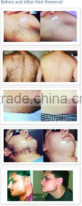 Multi-function IPL Machine Hair removal and acne improvement breast lifting