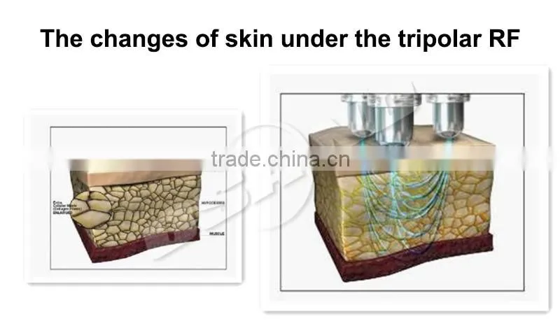 New invented machine high frequency skin tightening body slimming