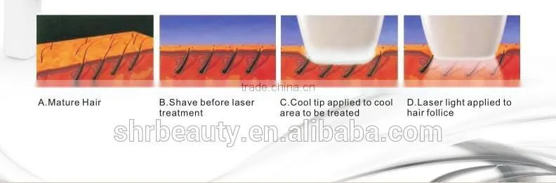 Hot sale Vertical 808nm Diode Laser Hair Removal