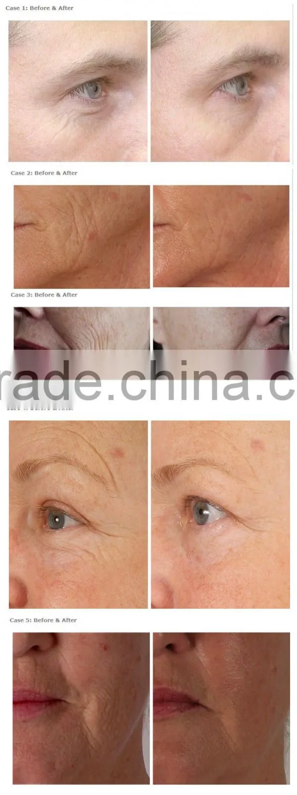 Micro Needle Derma Roller Medical Grade Needle Dermaroller