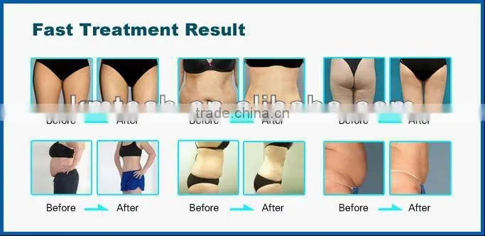 Hot selling cavitation rf machine with high quality for wrinkle removal