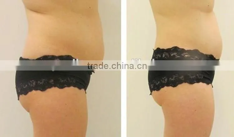 Ultrashape HIFU Body Slimming Cosmetic Hifu Slimming Device