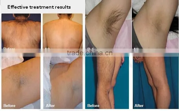 810nm diode laser for hair removal system with permanent results