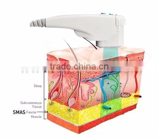 US360 high intensive focus untrasound wrinkle remove fat reduce