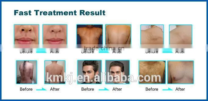 Distributors portable ipl / ipl hair removal