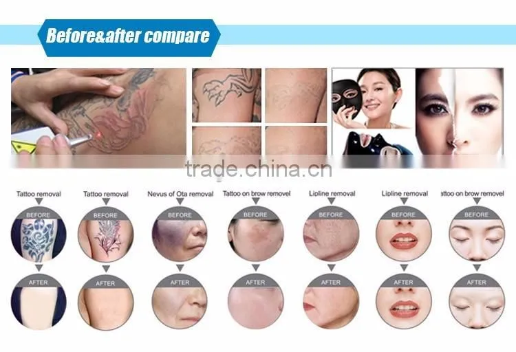 CE approved imported lamp 2 IN 1 elight IPL long pulsed nd yag laser hair removal