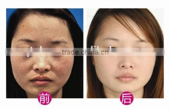 best nd yag q switched embroidery machines for tattoo removal tatoos permanent machine
