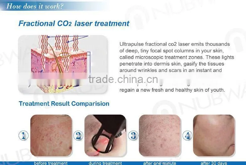 10600nm Laser Skin Resurfacing Medical Beauty Equipment RF Tube Fractional CO2 Laser