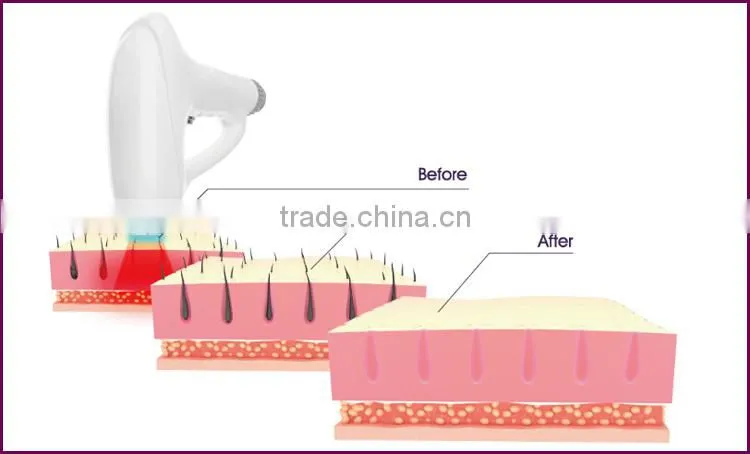 medical equipments laser hair machine price with low price