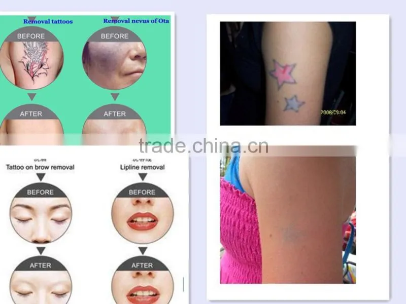 Best desktop Q swith nd yag Laser tattoo removal beauty machine