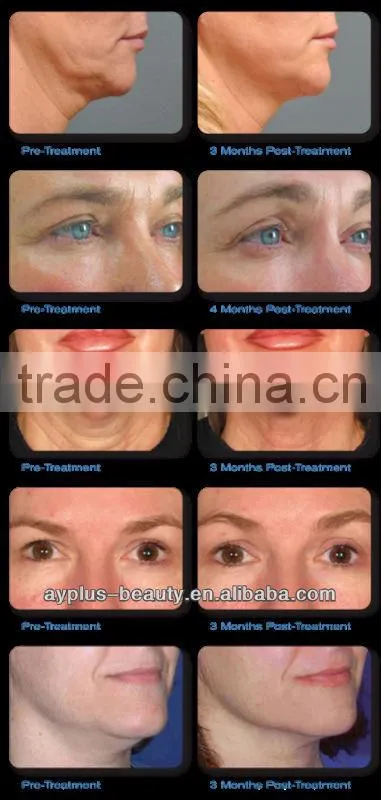 AYJ-H076(CE) ultrasonic facial massager