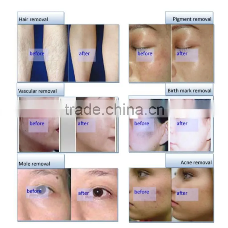Vascular lesions removal elight ipl , ce approved laser hair removal machine,shr hair removal opt laser