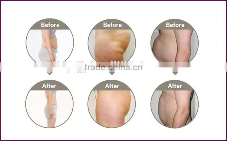 2016 fat freeze better cooling ultrasound weight loss equipment