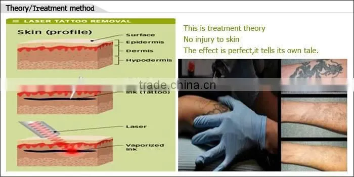 laser tatto removal machine/Yag laser tattoo laser beauty equipment