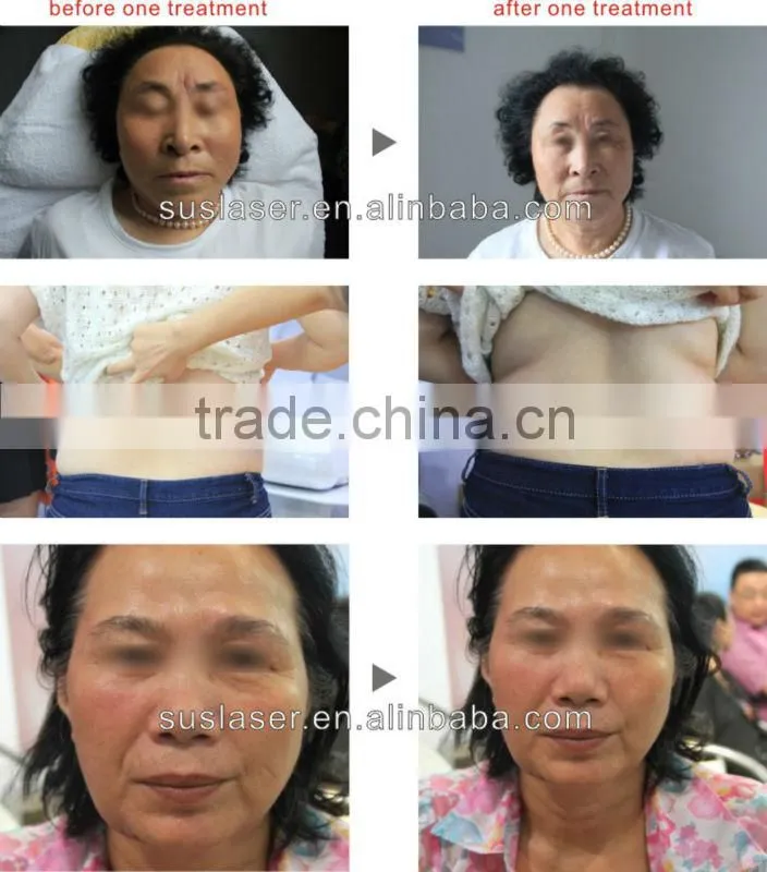 2015 newest! body sculpting massage machine velaslim radio frequency equipment S80 CE/ISO