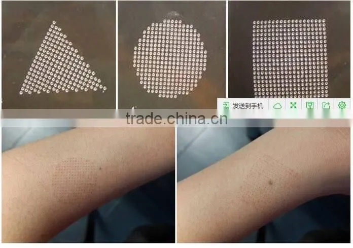 CE approved best quality cosmetics CO2 fractional acne scar wrinkle removal co2 laser machine for pores removal vagina tighten