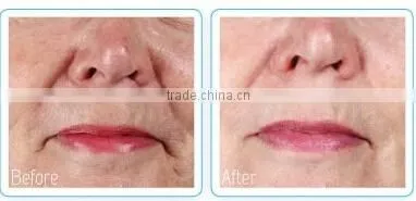 Fractional rf micro needle / microneedle rf machine