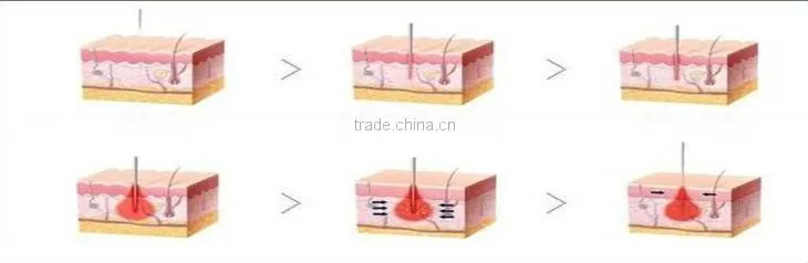 Portable RF Fractional Microneedle Anti-aging Skin Lifting Wrinkle Remover Machine Professional For Beauty Salon