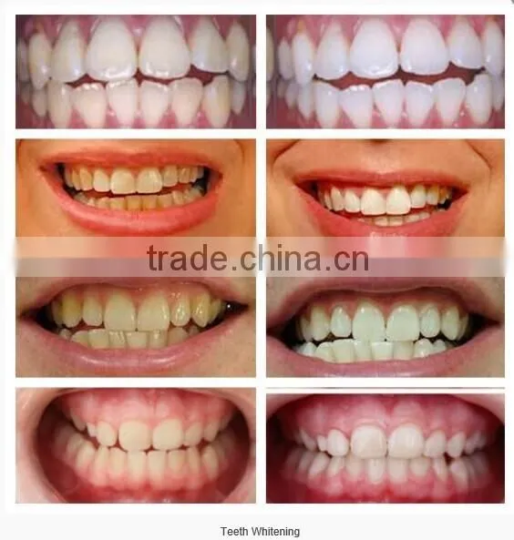 Teeth whitening machine te200 led,teeth whitening lamp