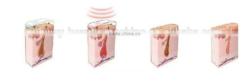 Diode Hair Removal Laser As Lumenis Lightsheer Duet And Alma Soprano XL