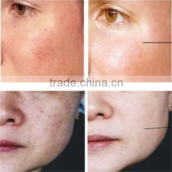 Fast skin rejuvenation and tightening beauty machine portable intracel fractional rf microneedle