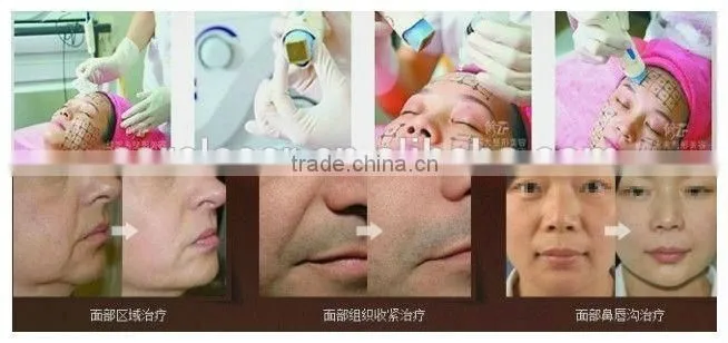 rf face lifting and freckle removal equipment
