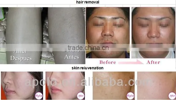 Apolomed new 808 laser diode hair removal system