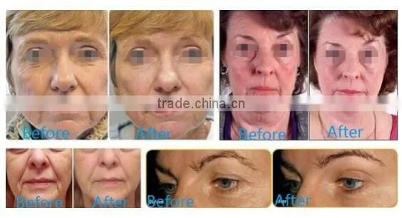 HIFU-C HIFU wrinkle removal equipment