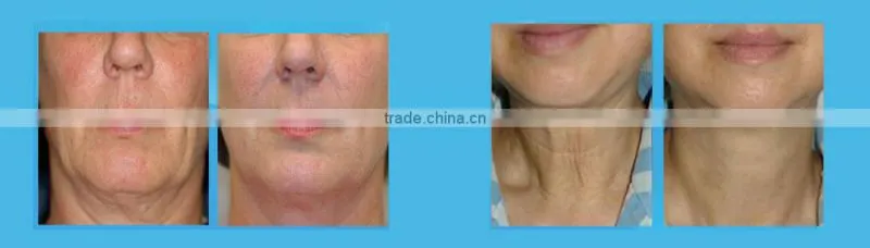 Hottest!!! Anti-wrinkle High Intensity Focused Ultrasound Knife