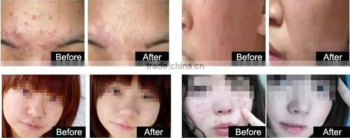 Best sale newest intensive pulse light ipl hair removal