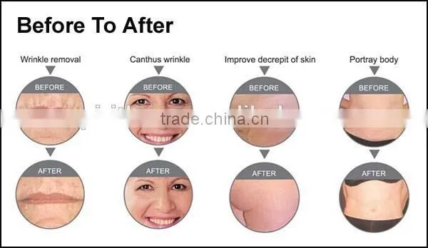 Radio Frequency Fractional rf machine skin tightings machine Best Beauty Salon Machine