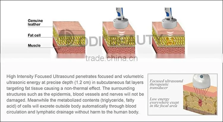 25%OFF! 2015 Supersonic fast weight loss hifu body shape OD-R100