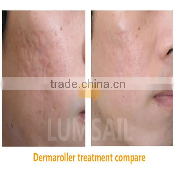 New arrival Derma Roller titanium needle 540 DEEDLE derma roller 0.5 mm derma roler