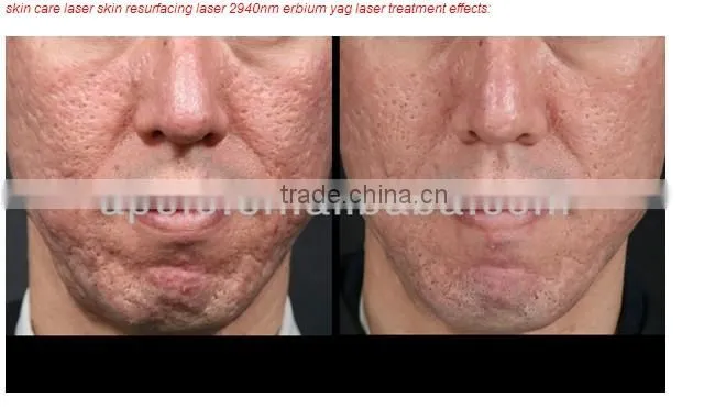2940nm Er yag fractional laser scar removal machine HS-820