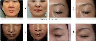 YUWEI new technology 2D dimision hifu/ portable 2D hifu machine for face and body